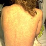 The back of a child suffering from rubeola.