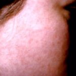Rubella facial rash on the high cheek of a woman.