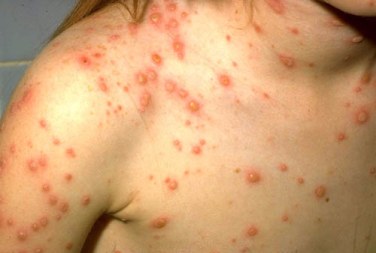An adolescent female's shoulder and chest with chickenpox (varicella) lesions at various stages.