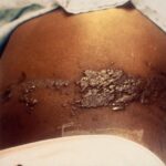 Child with a history of leukemia with a maculopapular rash.
