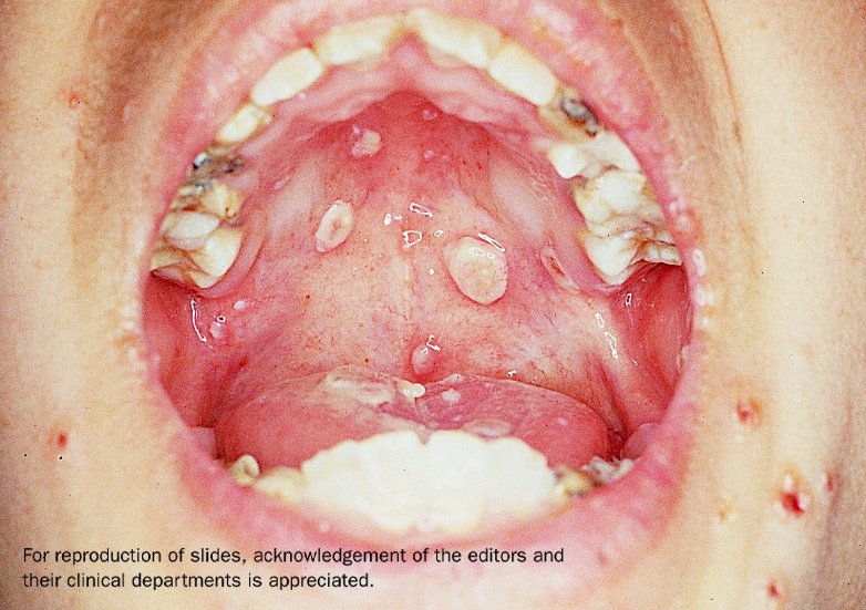 An open mouth showing chickenpox on the roof of their mouth.