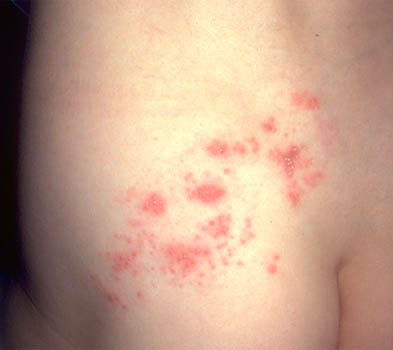 Herpes zoster (shingles) on a patient's shoulder.